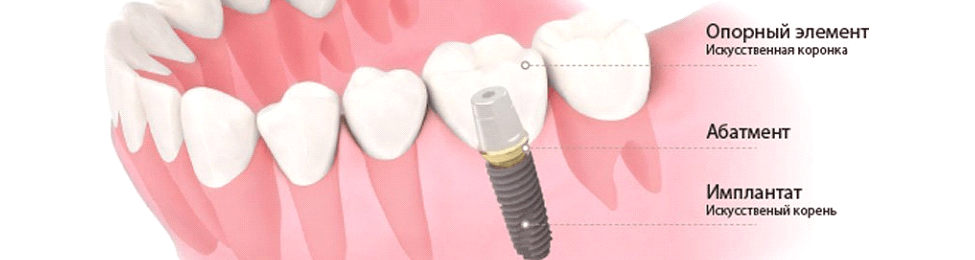 особенности и преимущества имплантации зубов ОССТЕМ